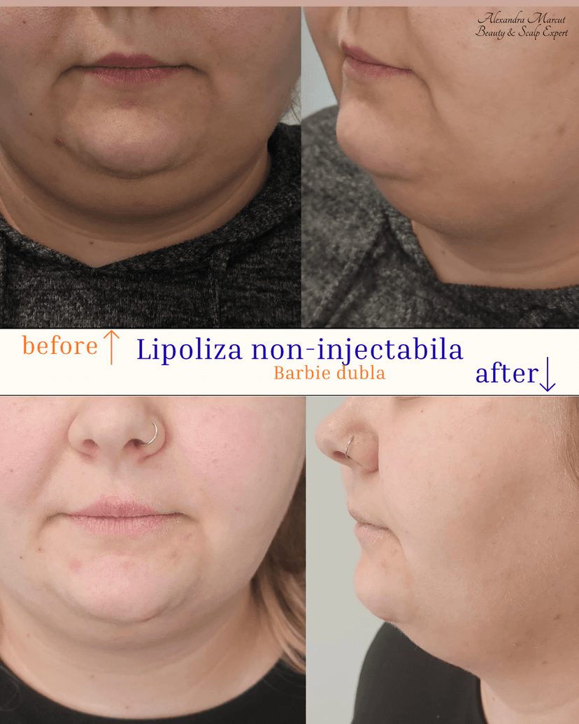 lipoza.png