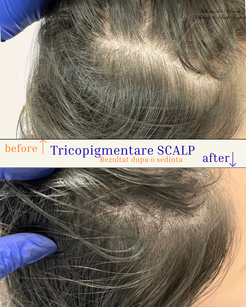 tricopigmentare1.png